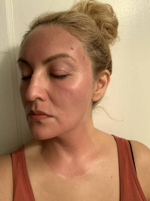 HALO LASER Treatment Healing Case: 1 Hour After Left-side