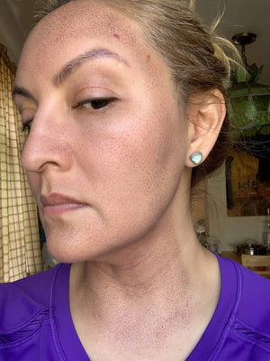 HALO LASER Treatment Healing Case: 2 Days After Left-side