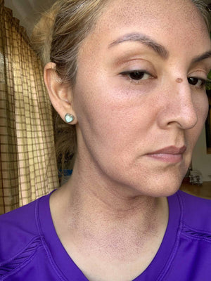 HALO LASER Treatment Healing Case: 2 Days After Right-side