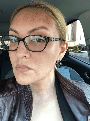 HALO LASER Treatment Healing Case: 3 Days After Left-side