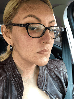 HALO LASER Treatment Healing Case: 3 Days After Right-side