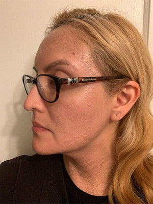 HALO LASER Treatment Healing Case: 4 Days After Left-side