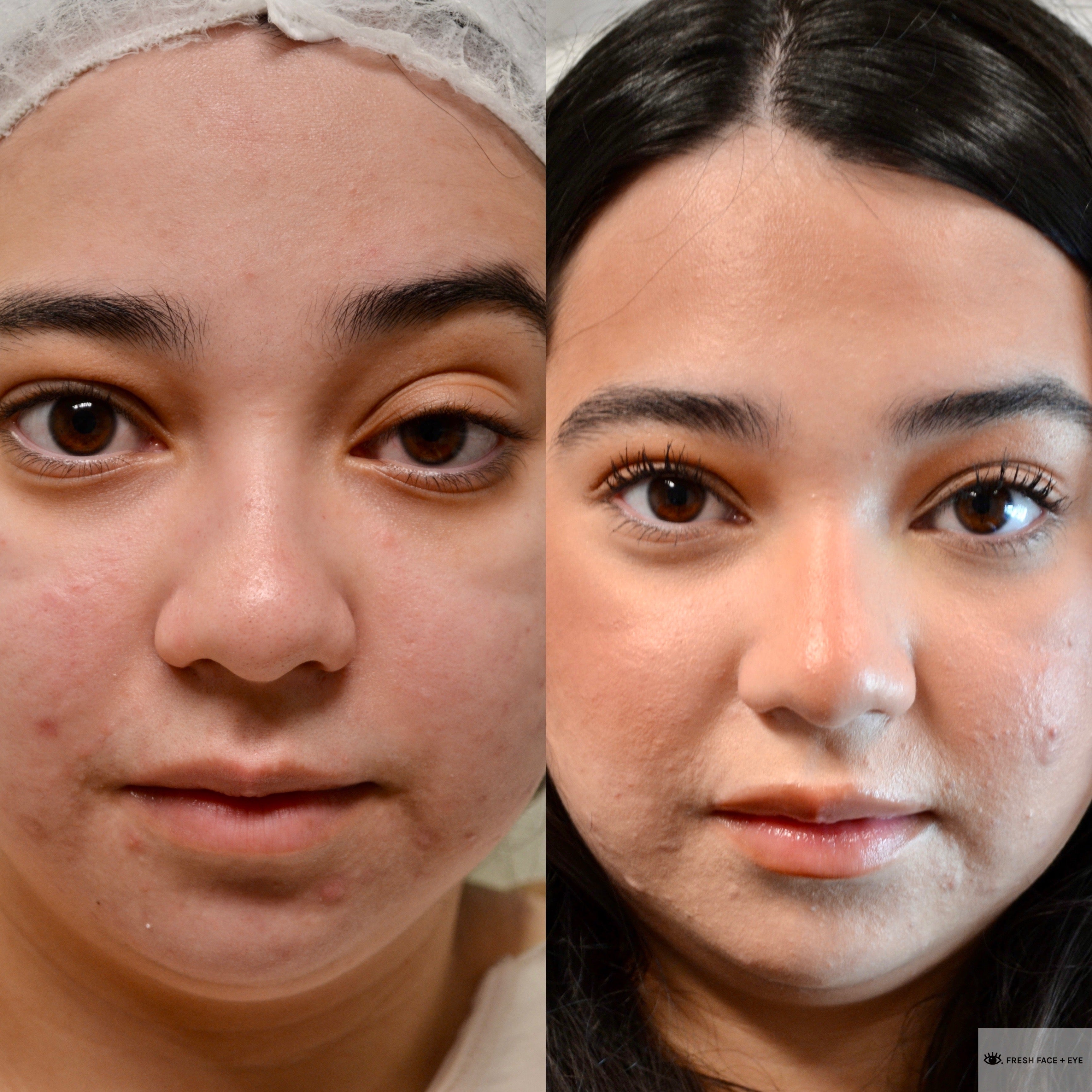 UPPER EYELID SURGERY (BLEPHAROPLASTY) BEFORE & AFTER PHOTO. SURGERY BY DR. BALJEET K. PUREWAL (OCULOPLASTIC SURGEON) IN NEW JERSEY.