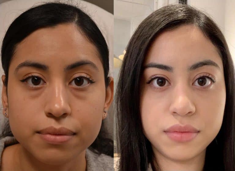 LOWER EYELID SURGERY (BLEPHAROPLASTY) BEFORE & AFTER PHOTO. SURGERY BY DR. BALJEET K. PUREWAL (OCULOPLASTIC SURGEON) IN NEW JERSEY.