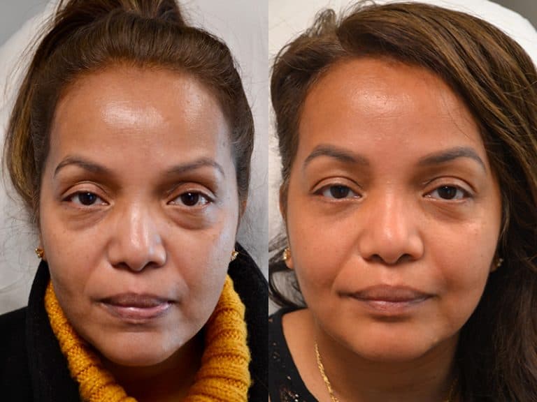 LOWER EYELID SURGERY (BLEPHAROPLASTY) BEFORE & AFTER PHOTO. SURGERY BY DR. BALJEET K. PUREWAL (OCULOPLASTIC SURGEON) IN NEW JERSEY.