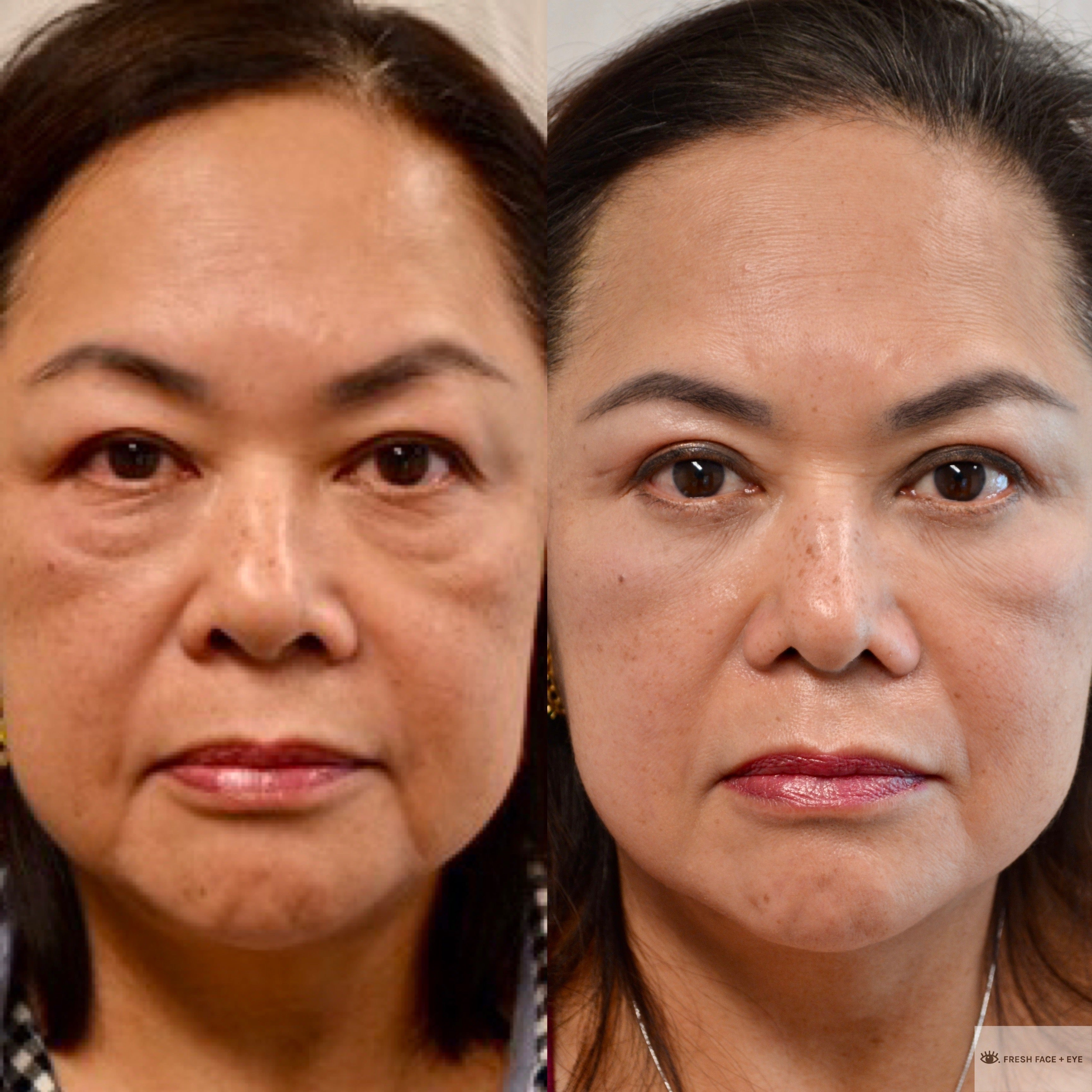 UPPER & LOWER EYELID SURGERY (BLEPHAROPLASTY) BEFORE & AFTER PHOTO. SURGERY BY DR. BALJEET K. PUREWAL (OCULOPLASTIC SURGEON) IN NEW JERSEY.