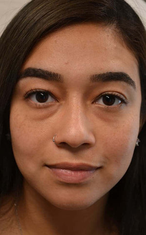 Lower Eyelid Surgery Healing Case: Before