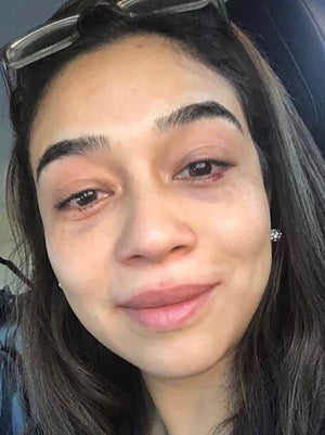 Lower Eyelid Surgery Healing Case: Day 1