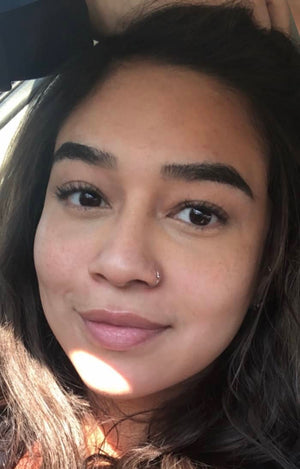 Lower Eyelid Surgery Healing Case: Day 7