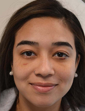 Lower Eyelid Surgery Healing Case: Day 30