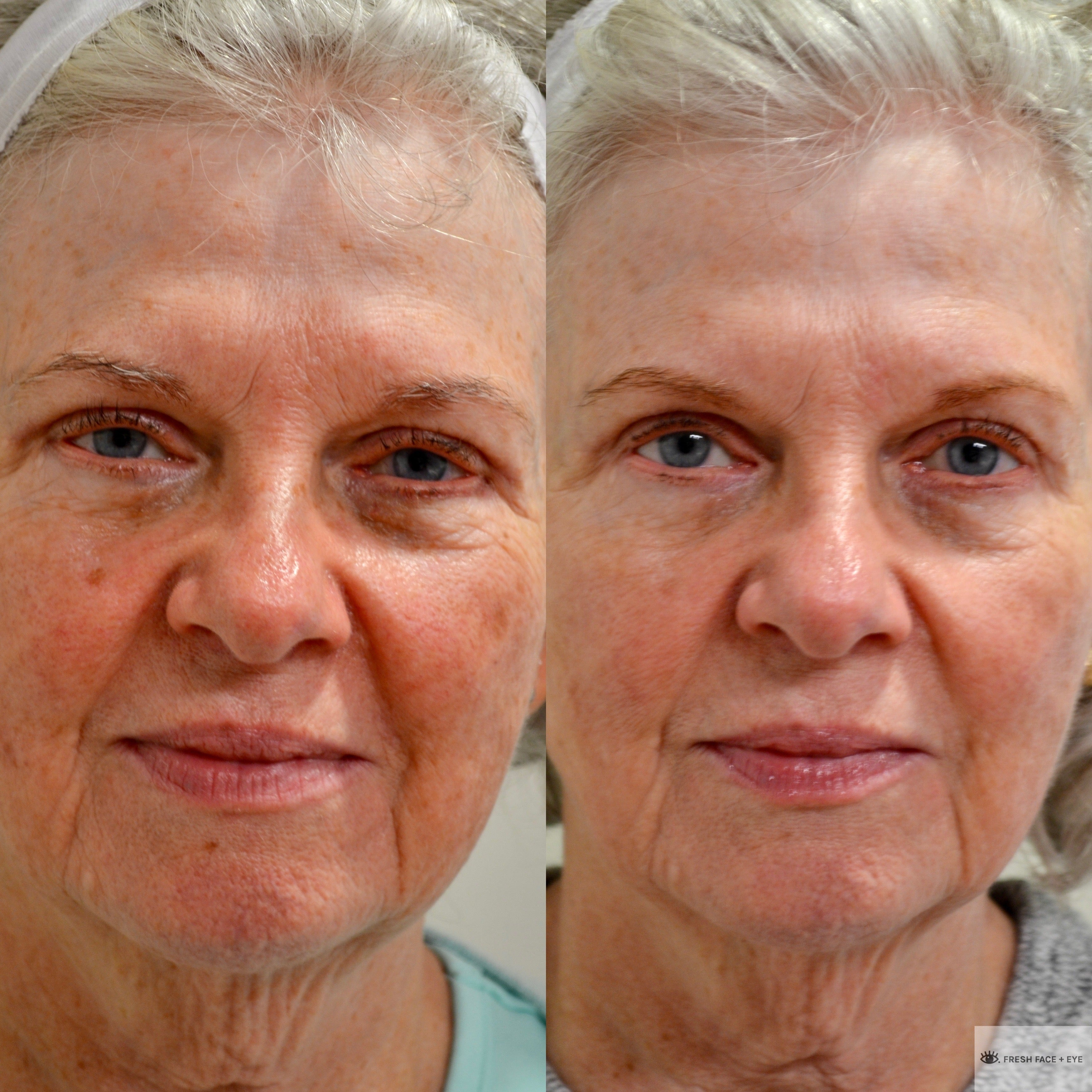 BBL PHOTOFACIAL BEFORE & AFTER PHOTO. PROCEDURE PERFORMED BY DR. BALJEET K. PUREWAL (OCULOPLASTIC SURGEON) IN NEW JERSEY.