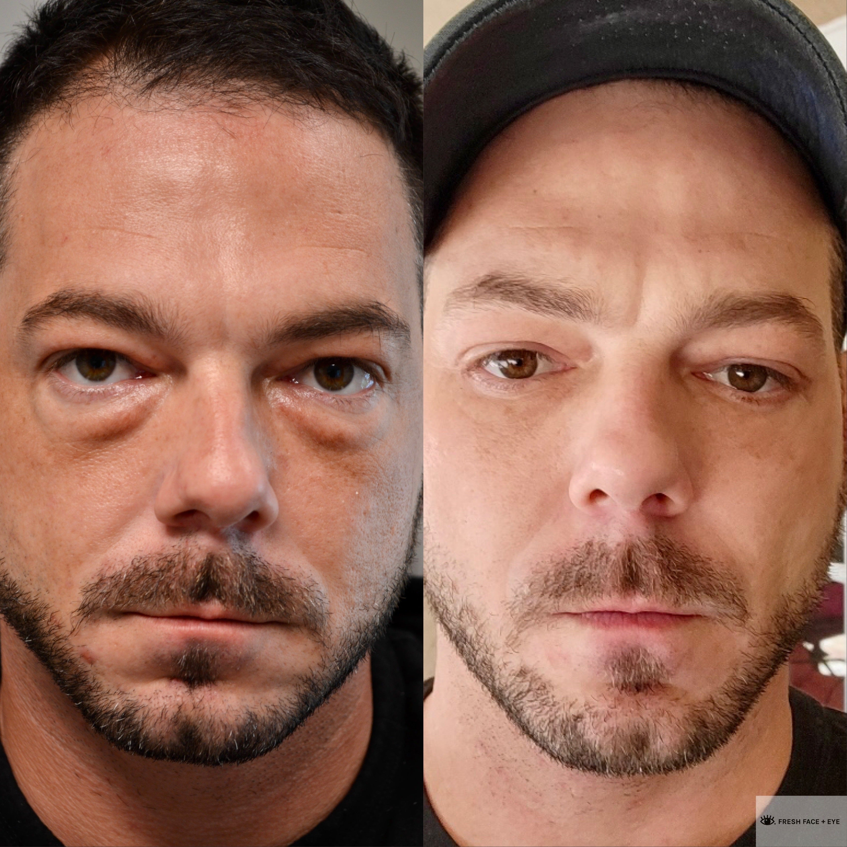 OWER EYELID SURGERY (BLEPHAROPLASTY) BEFORE & AFTER PHOTO. SURGERY BY DR. BALJEET K. PUREWAL (OCULOPLASTIC SURGEON) IN NEW JERSEY.