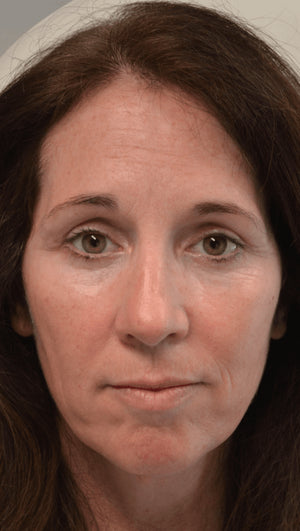 Eyelid Surgery Healing Case: Day 30