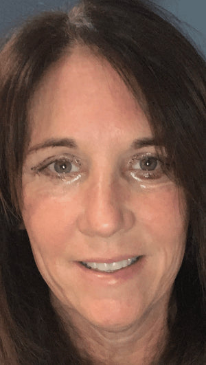 Eyelid Surgery Healing Case: Day 2