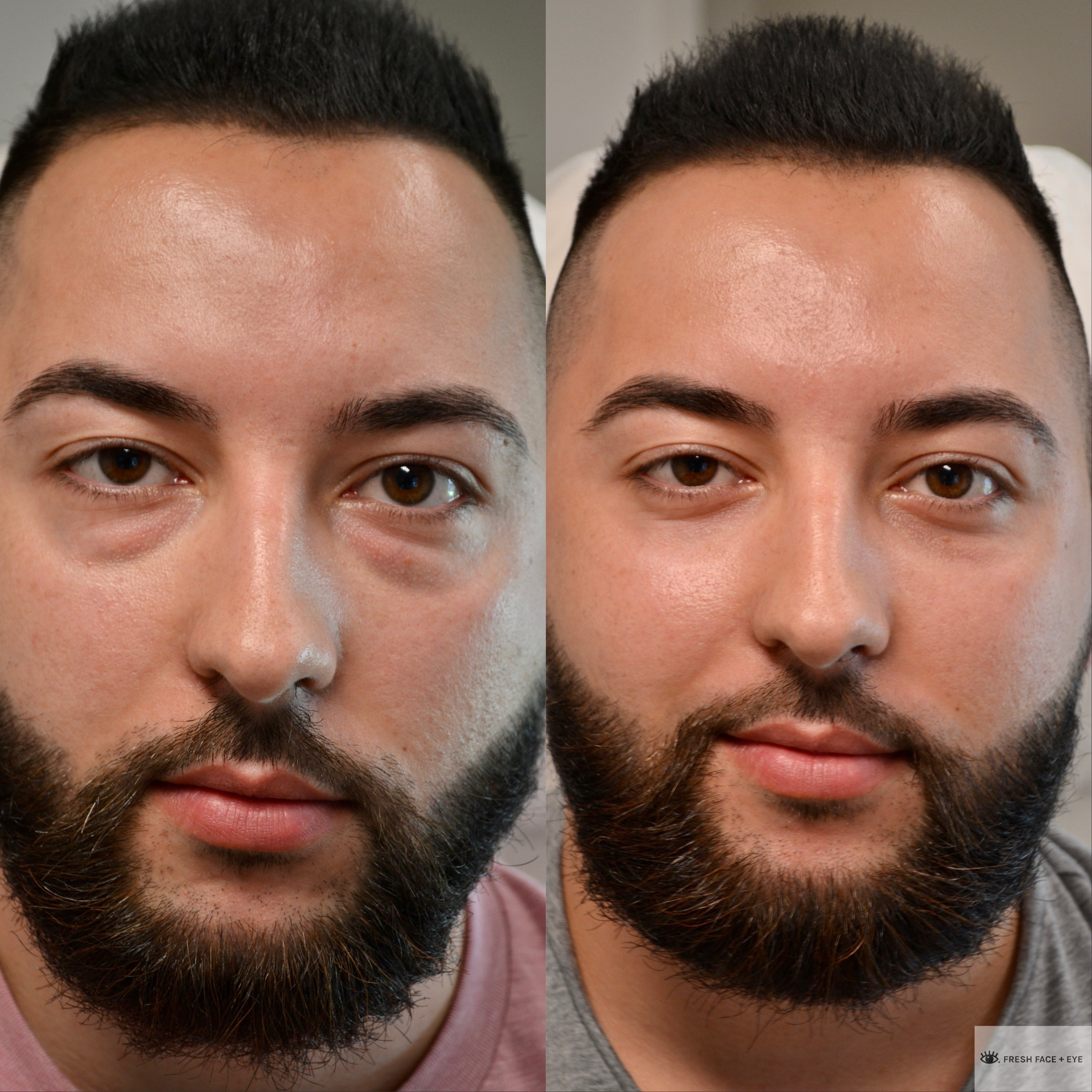 LOWER EYELID SURGERY (BLEPHAROPLASTY) BEFORE & AFTER PHOTO. SURGERY BY DR. BALJEET K. PUREWAL (OCULOPLASTIC SURGEON) IN NEW JERSEY
