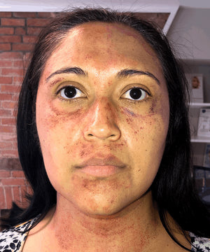 Microneedling Treatment Healing Case: Immediately After