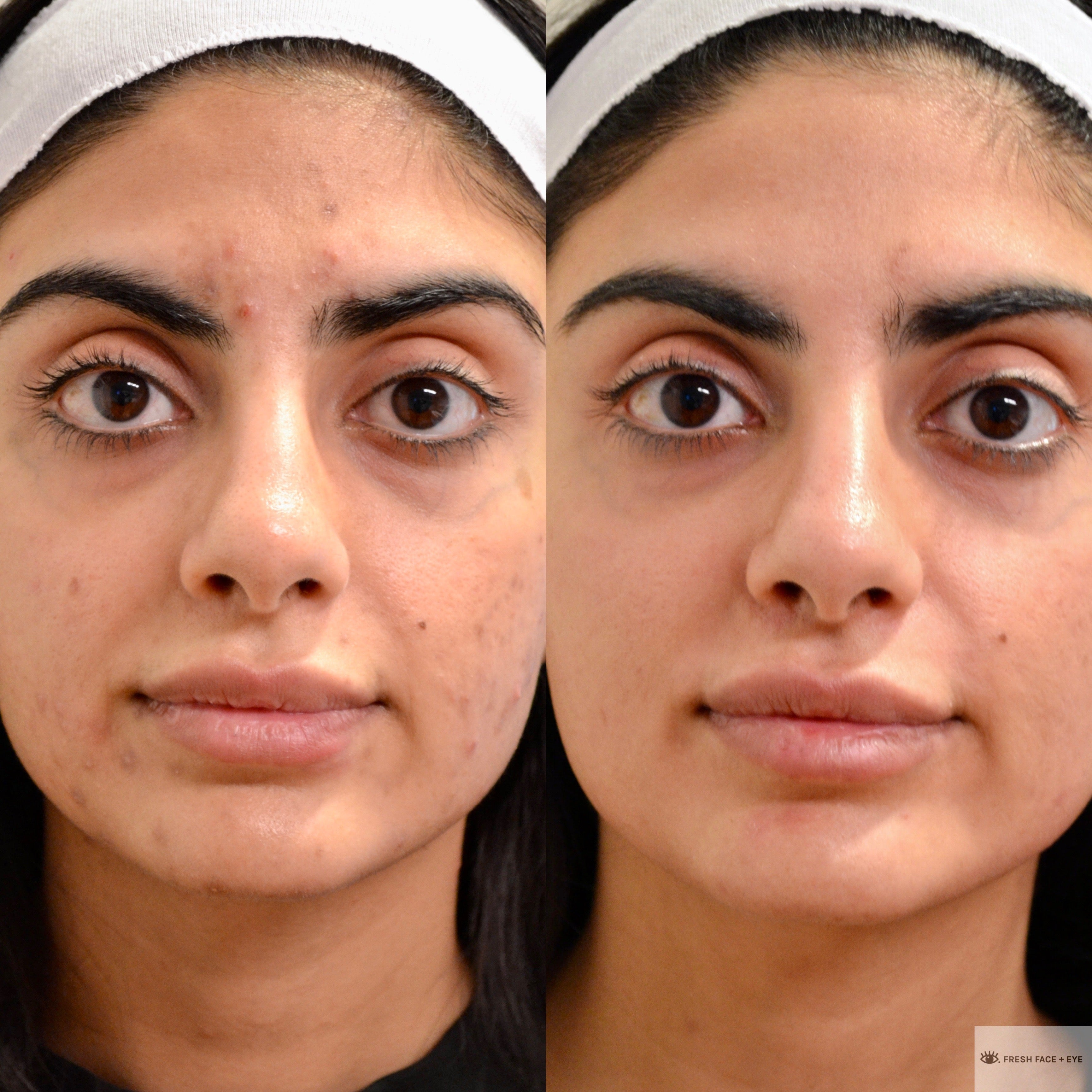 BBL PHOTOFACIAL BEFORE & AFTER PHOTO. PROCEDURE PERFORMED BY DR. BALJEET K. PUREWAL (OCULOPLASTIC SURGEON) IN NEW JERSEY.