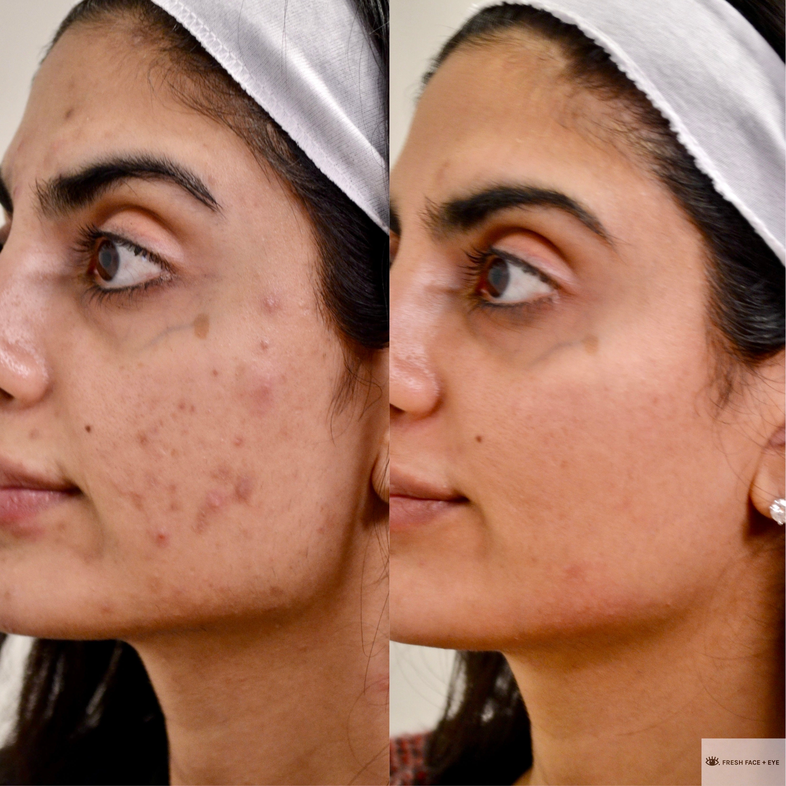 BBL PHOTOFACIAL BEFORE & AFTER PHOTO. PROCEDURE PERFORMED BY DR. BALJEET K. PUREWAL (OCULOPLASTIC SURGEON) IN NEW JERSEY.