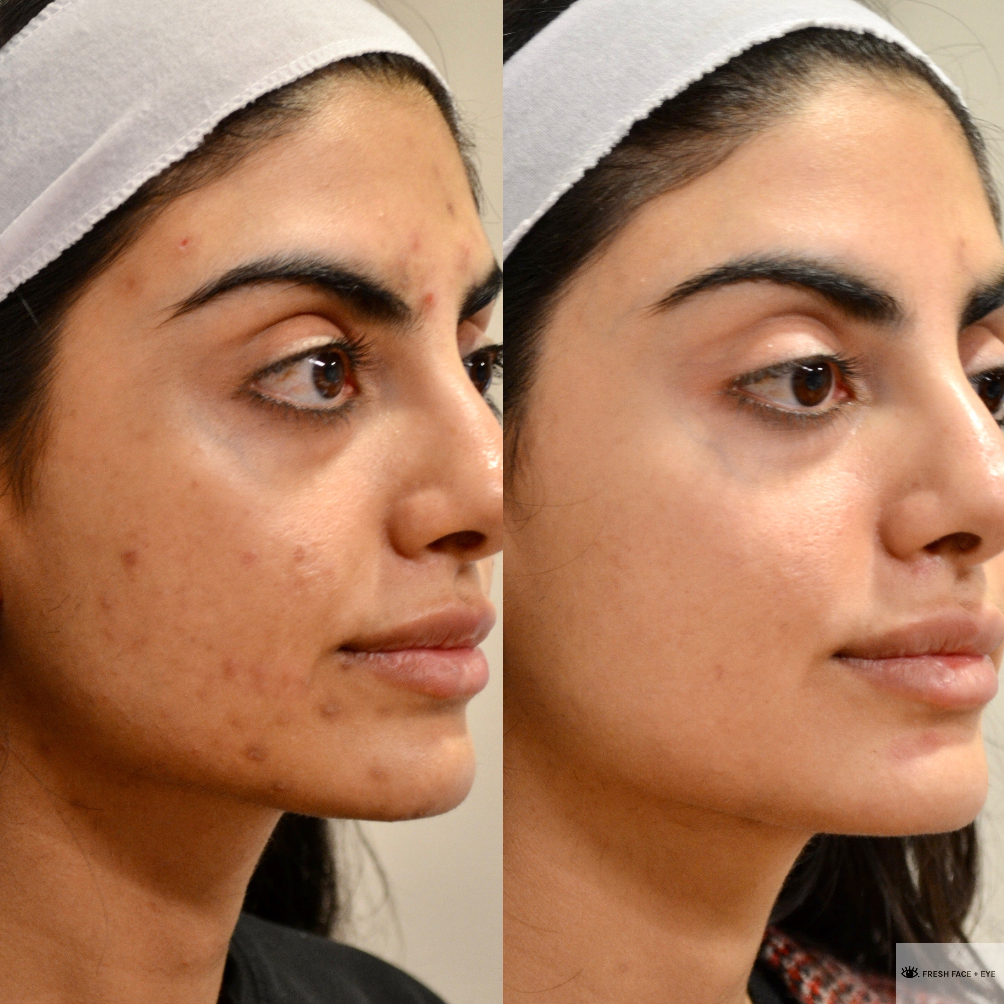 BBL PHOTOFACIAL BEFORE & AFTER PHOTO. PROCEDURE PERFORMED BY DR. BALJEET K. PUREWAL (OCULOPLASTIC SURGEON) IN NEW JERSEY.