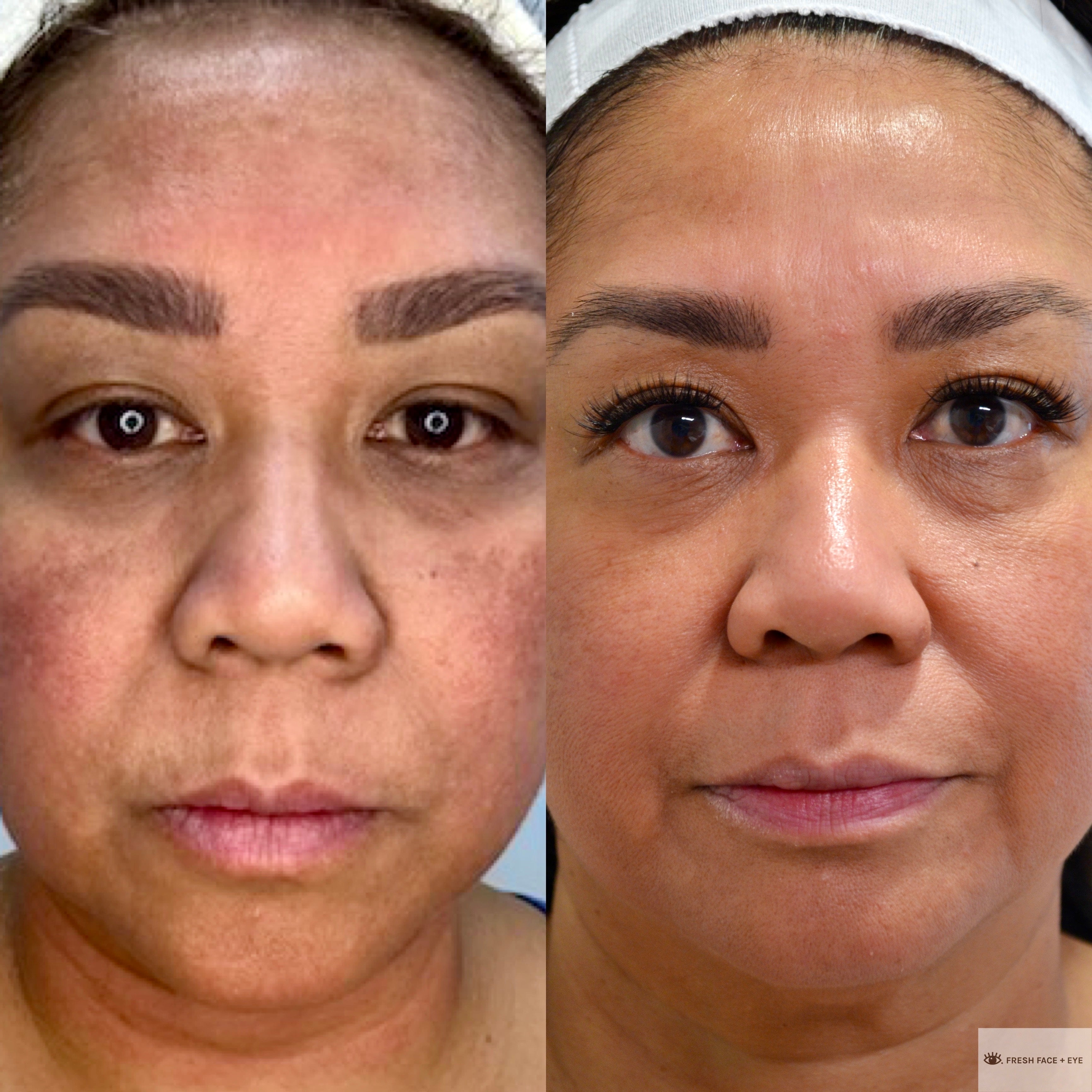 COMBINATION THERAPY BEFORE & AFTER PHOTO. PROCEDURE BY DR. BALJEET K. PUREWAL (OCULOPLASTIC SURGEON) IN NEW JERSEY.