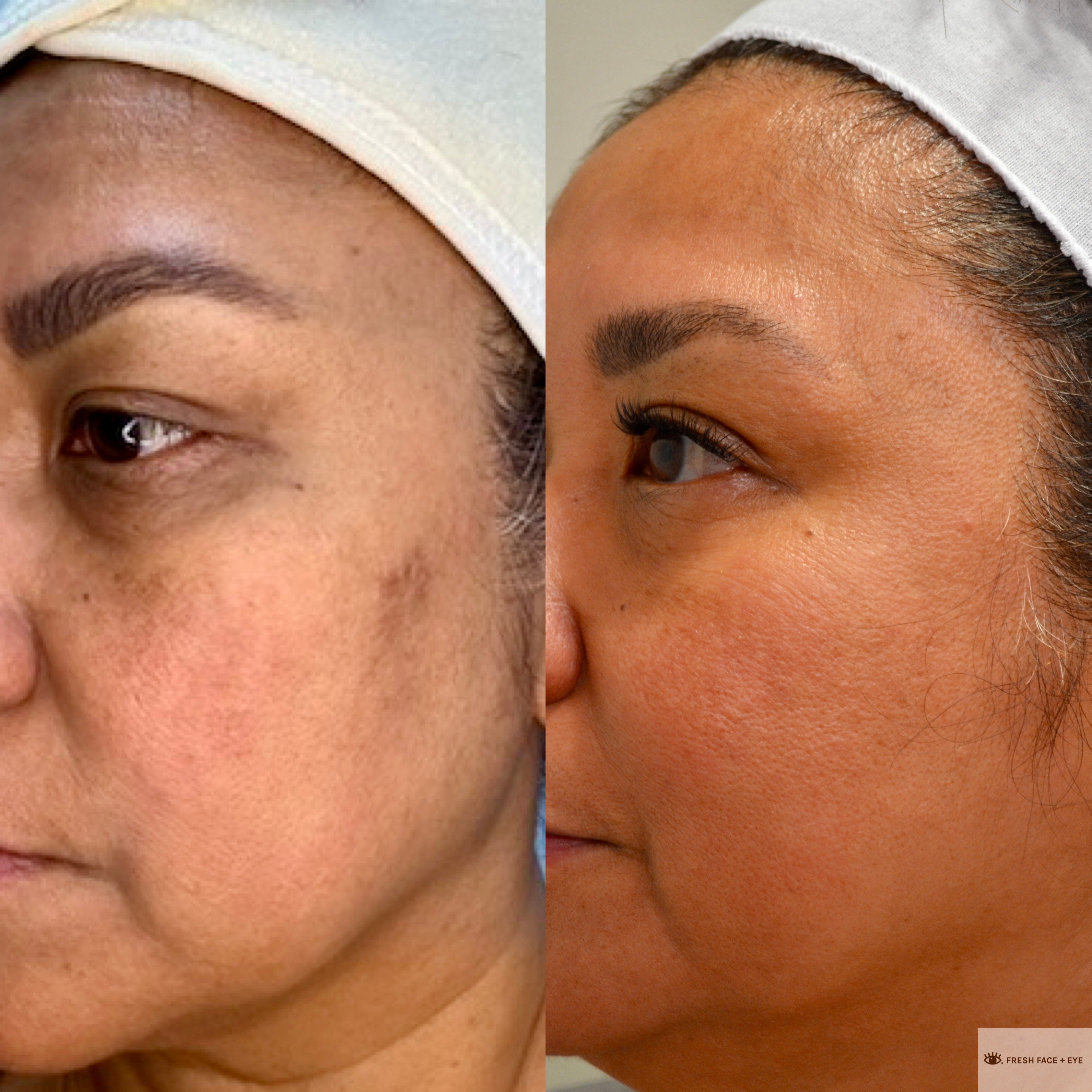 COMBINATION THERAPY BEFORE & AFTER PHOTO. PROCEDURE BY DR. BALJEET K. PUREWAL (OCULOPLASTIC SURGEON) IN NEW JERSEY.