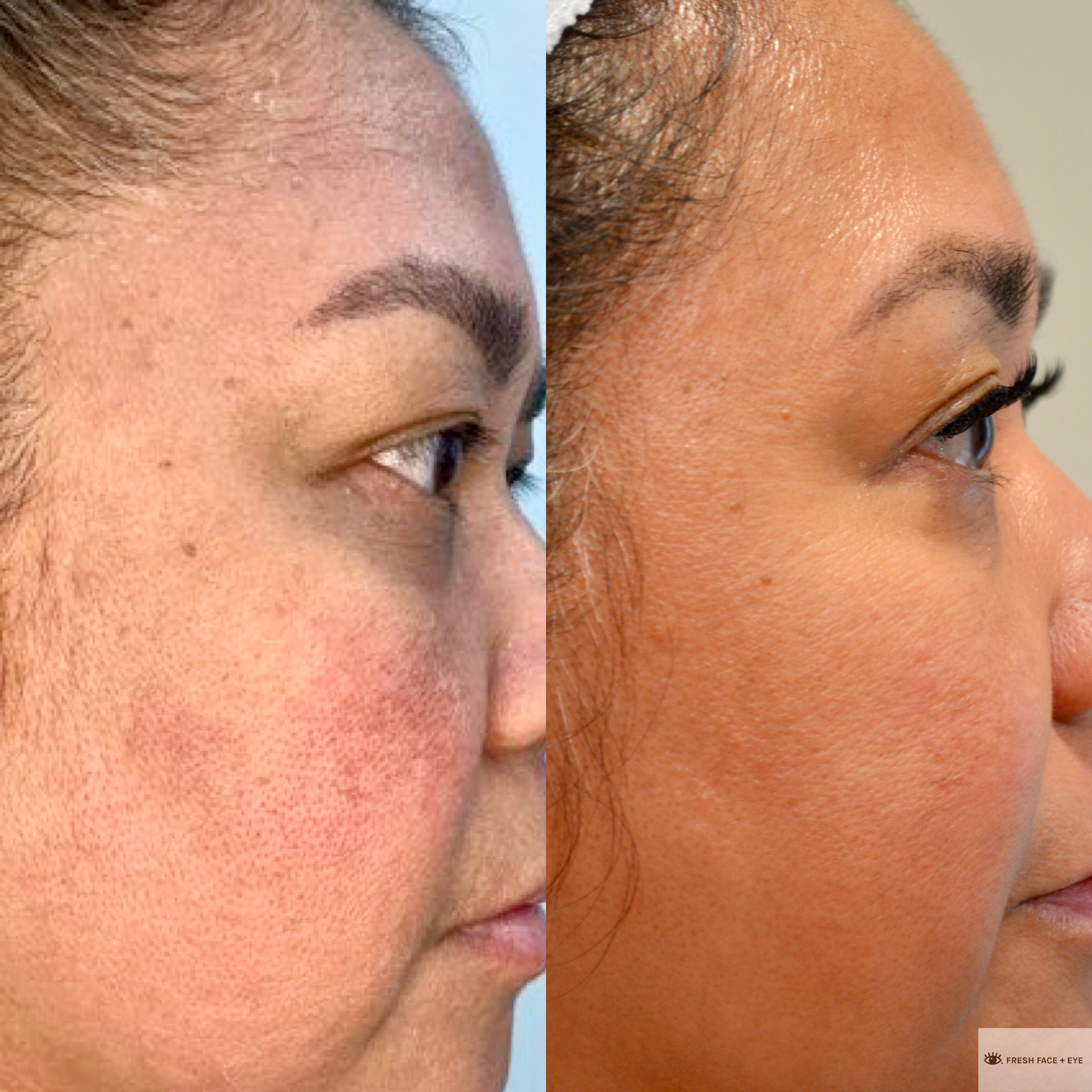 COMBINATION THERAPY BEFORE & AFTER PHOTO. PROCEDURE BY DR. BALJEET K. PUREWAL (OCULOPLASTIC SURGEON) IN NEW JERSEY.
