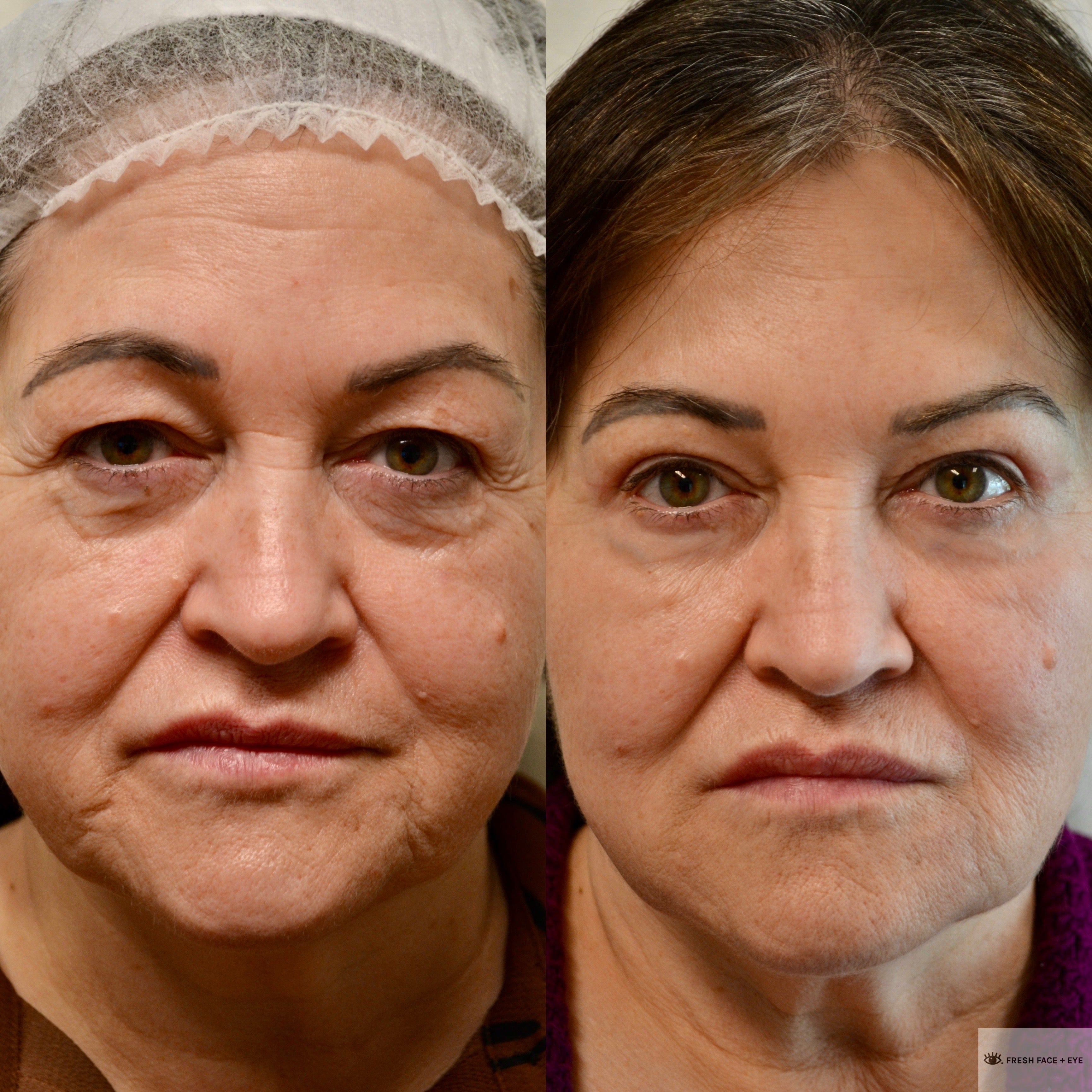 UPPER EYELID SURGERY (BLEPHAROPLASTY) BEFORE & AFTER PHOTO. SURGERY BY DR. BALJEET K. PUREWAL (OCULOPLASTIC SURGEON) IN NEW JERSEY.