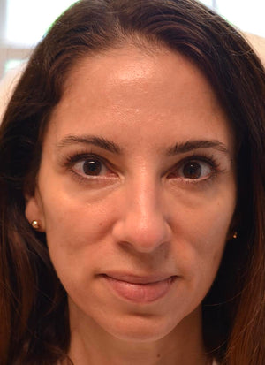 Upper Eyelid Surgery Healing Case: Day 30