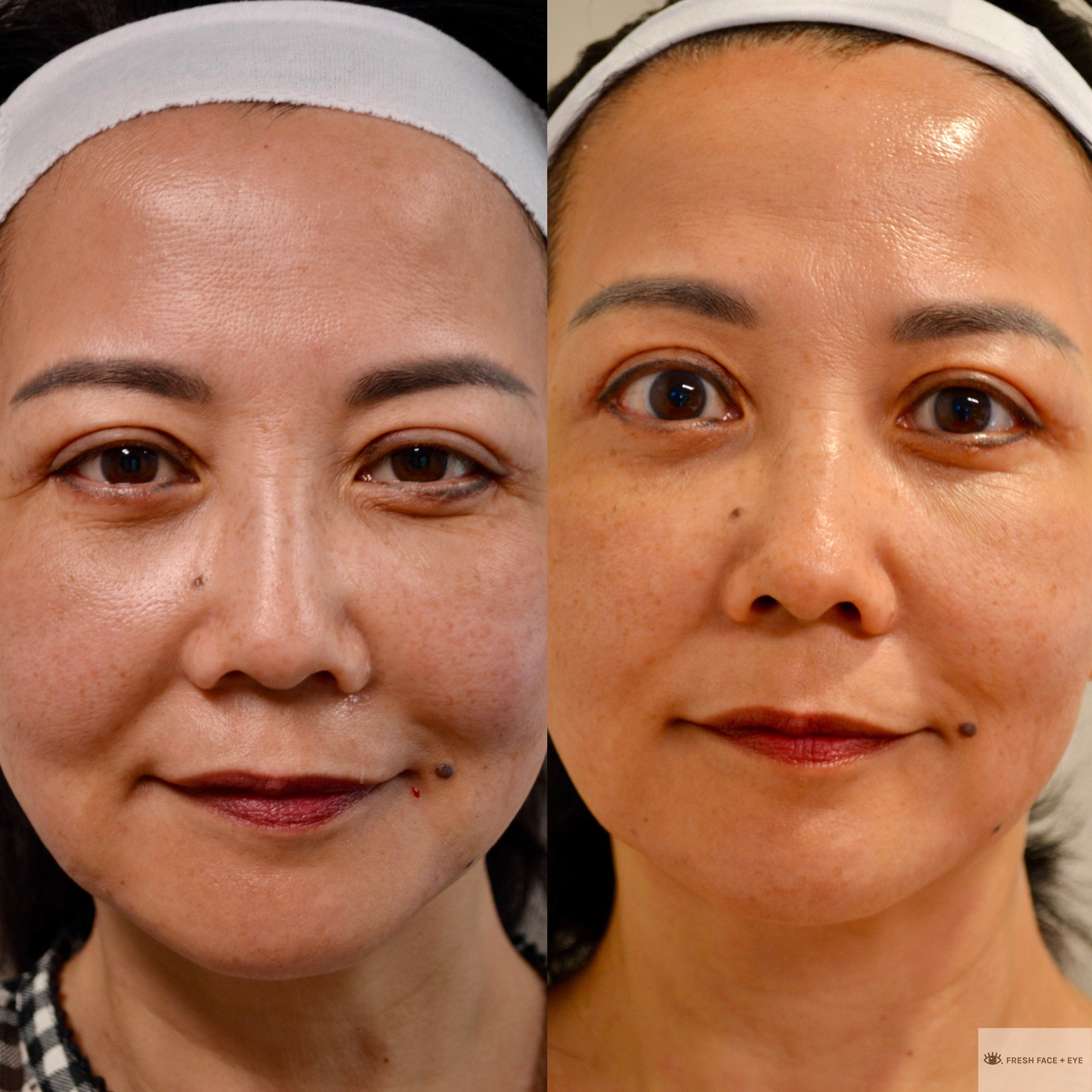 UPPER & LOWER EYELID SURGERY (BLEPHAROPLASTY) BEFORE & AFTER PHOTO. SURGERY BY DR. BALJEET K. PUREWAL (OCULOPLASTIC SURGEON) IN NEW JERSEY.