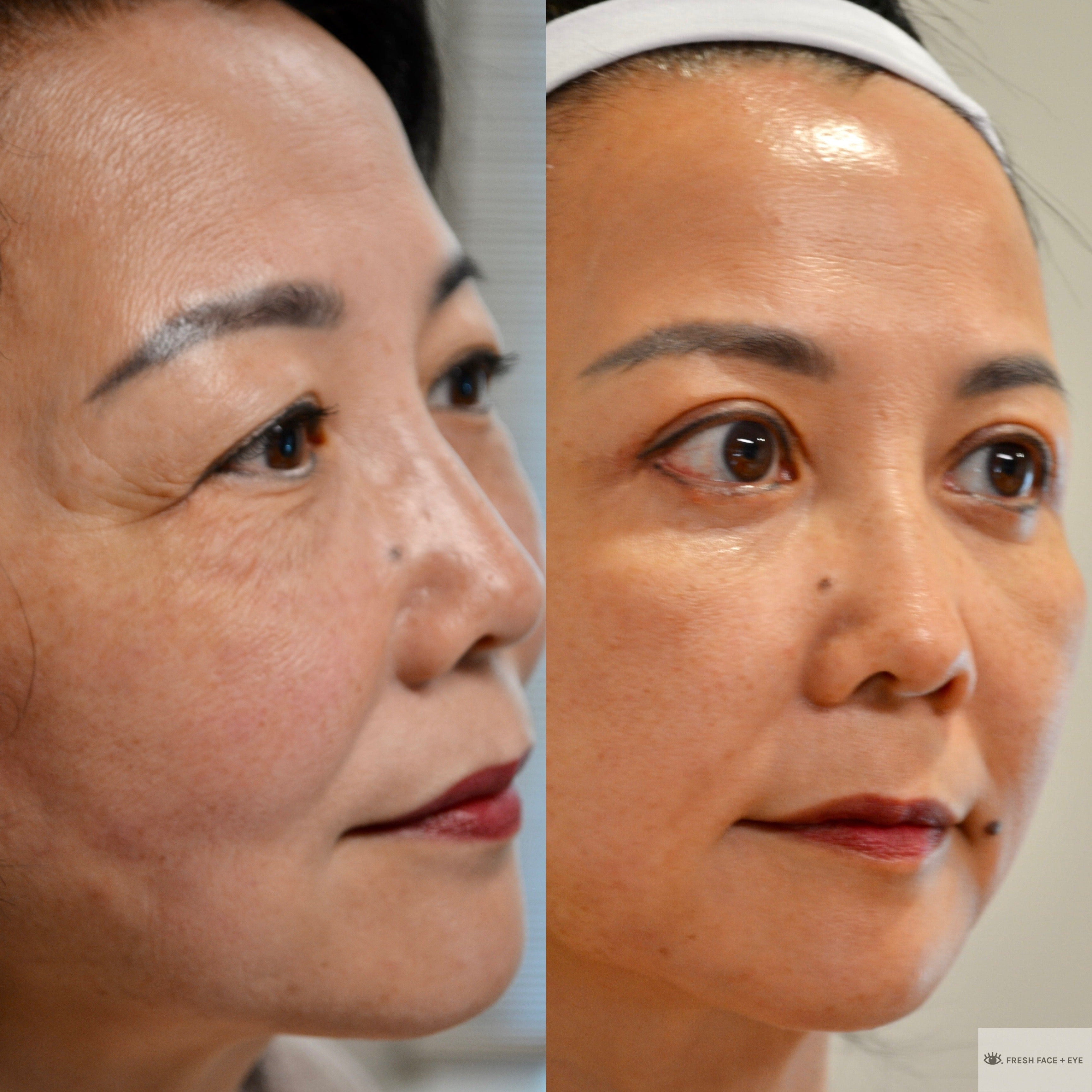 UPPER & LOWER EYELID SURGERY (BLEPHAROPLASTY) BEFORE & AFTER PHOTO. SURGERY BY DR. BALJEET K. PUREWAL (OCULOPLASTIC SURGEON) IN NEW JERSEY.