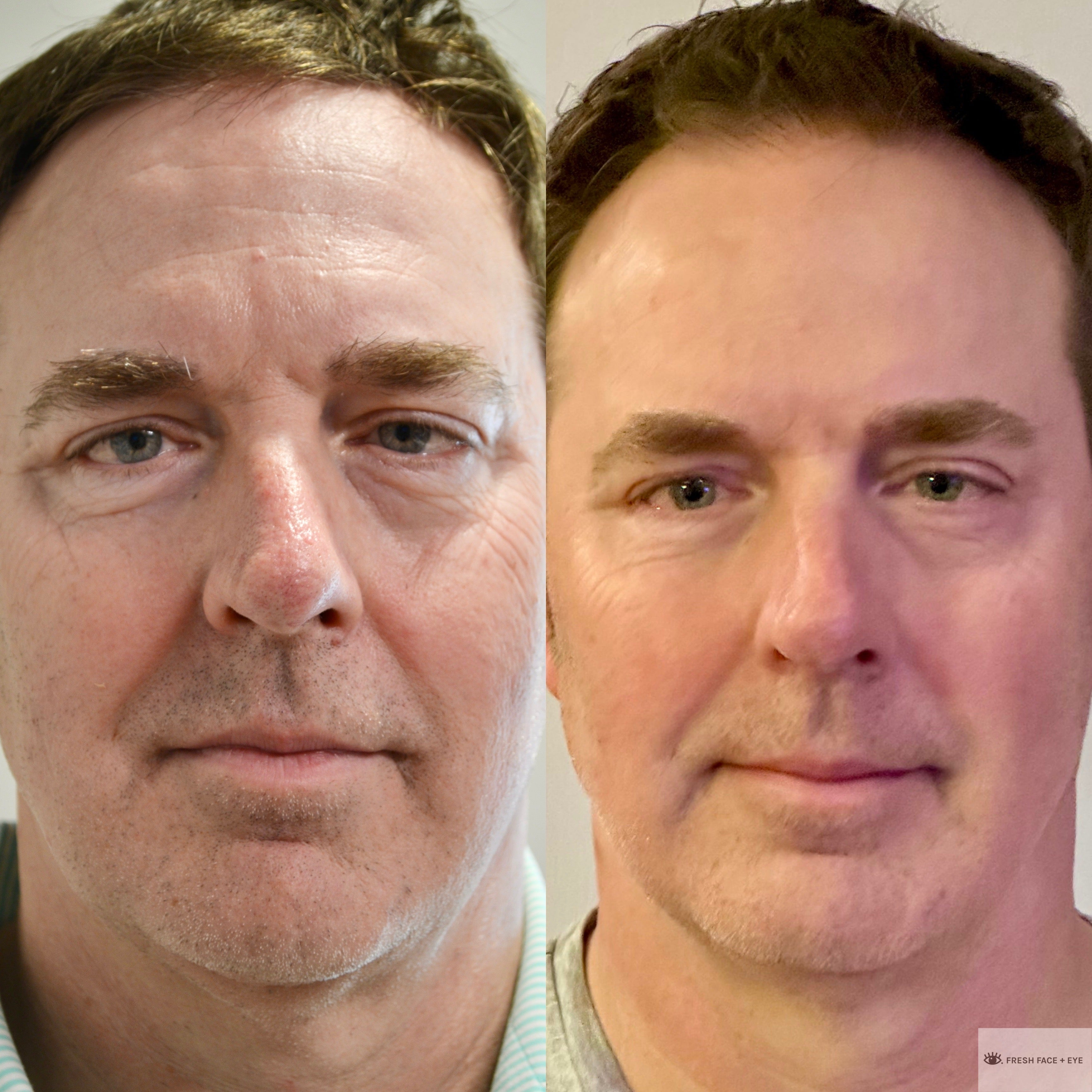 COMBINATION THERAPY BEFORE & AFTER PHOTO. PROCEDURE BY DR. BALJEET K. PUREWAL (OCULOPLASTIC SURGEON) IN NEW JERSEY.