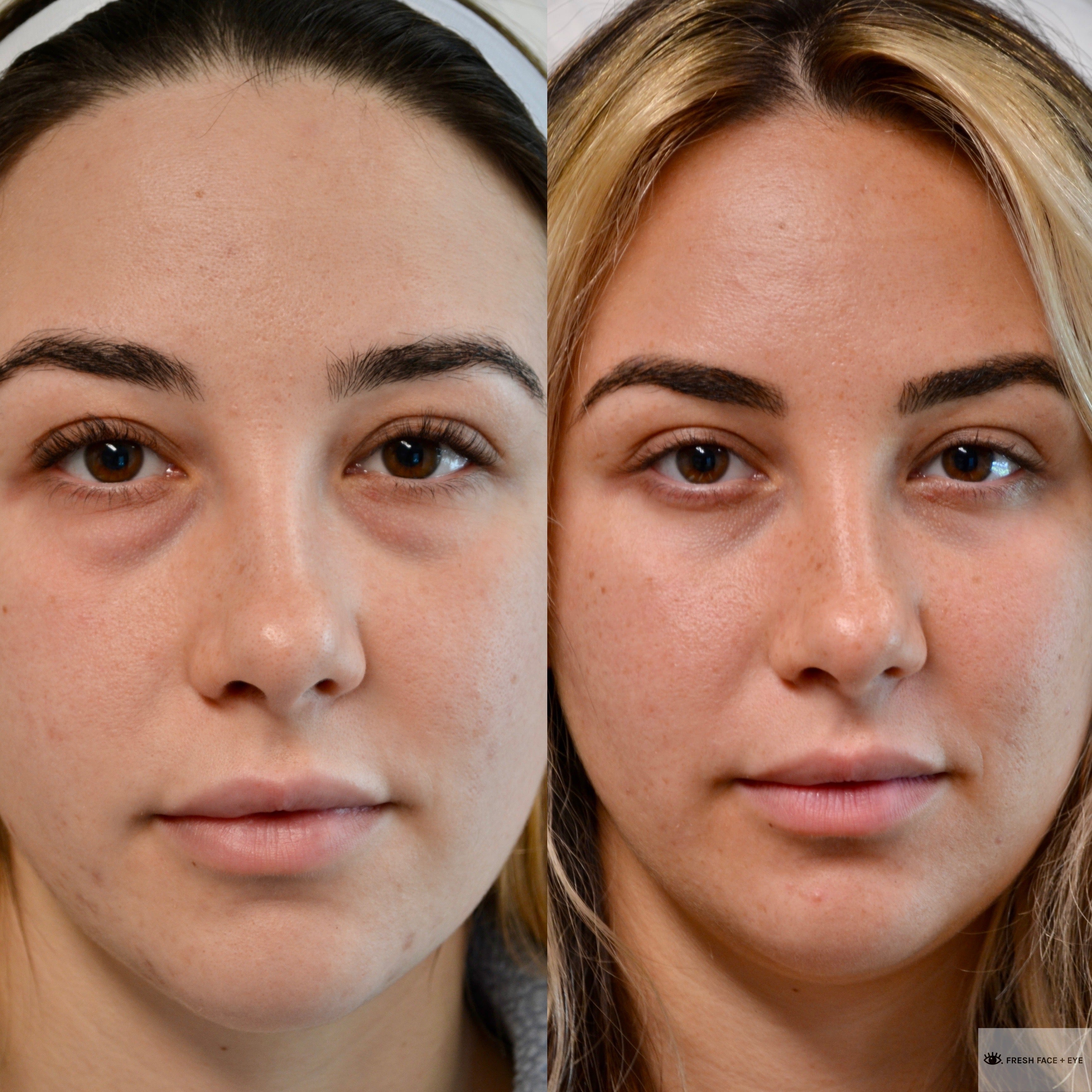 LOWER EYELID SURGERY (BLEPHAROPLASTY) BEFORE & AFTER PHOTO. SURGERY BY DR. BALJEET K. PUREWAL (OCULOPLASTIC SURGEON) IN NEW JERSEY.