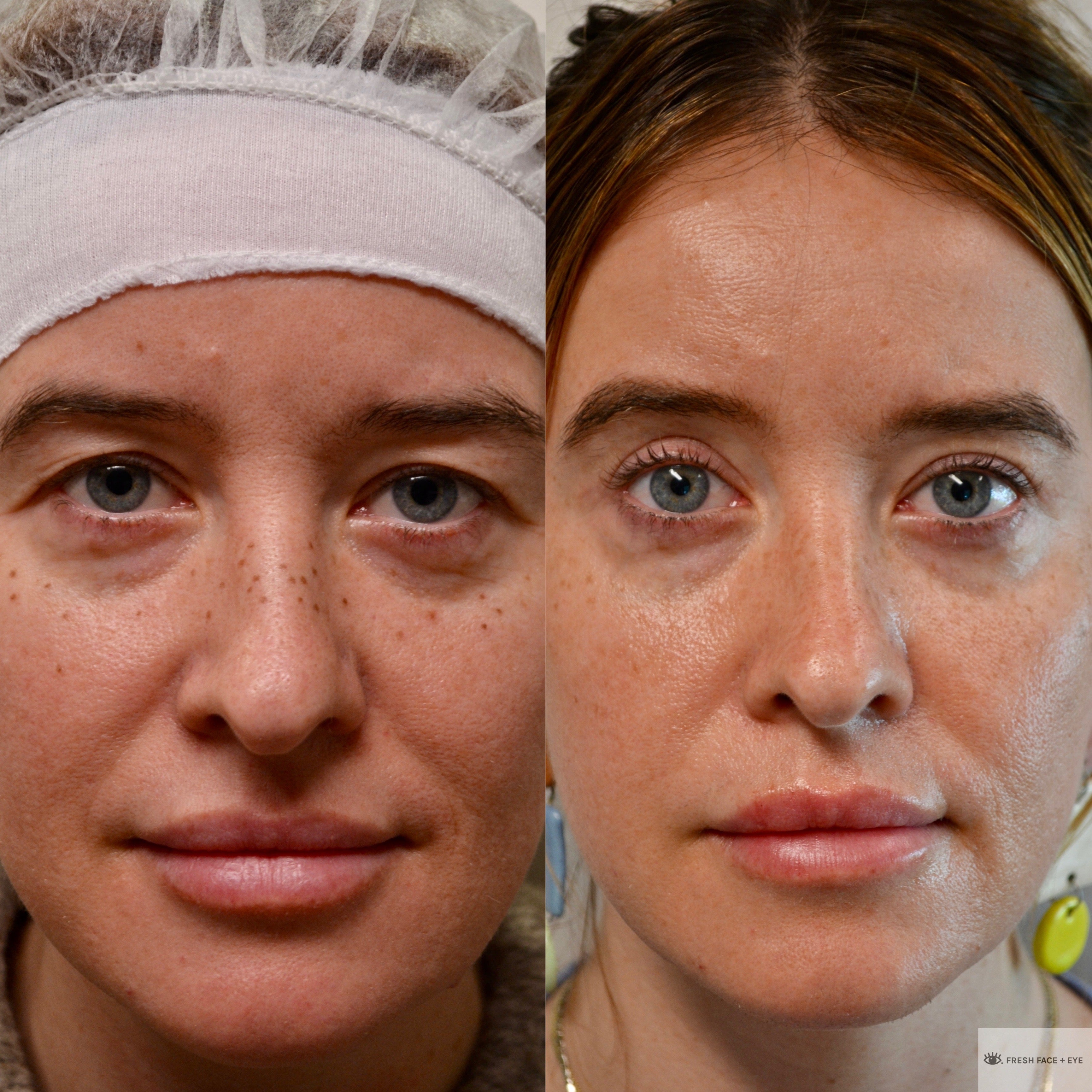 UPPER EYELID SURGERY (BLEPHAROPLASTY) BEFORE & AFTER PHOTO. SURGERY BY DR. BALJEET K. PUREWAL (OCULOPLASTIC SURGEON) IN NEW JERSEY.