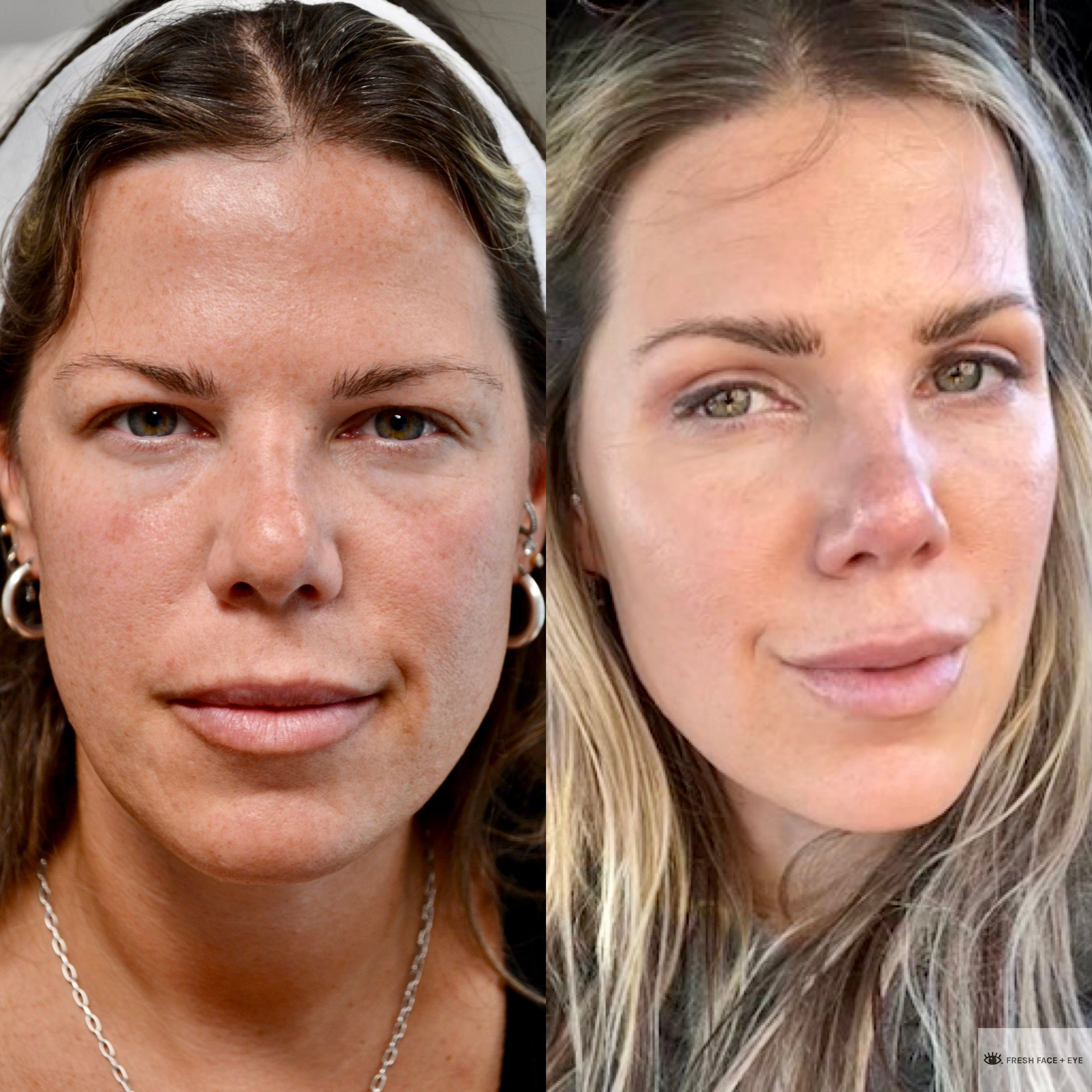 UPPER EYELID SURGERY (BLEPHAROPLASTY) BEFORE & AFTER PHOTO. SURGERY BY DR. BALJEET K. PUREWAL (OCULOPLASTIC SURGEON) IN NEW JERSEY.