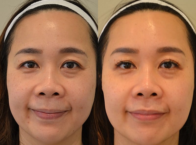 BBL PHOTOFACIAL BEFORE & AFTER PHOTO. PROCEDURE PERFORMED BY DR. BALJEET K. PUREWAL (OCULOPLASTIC SURGEON) IN NEW JERSEY.