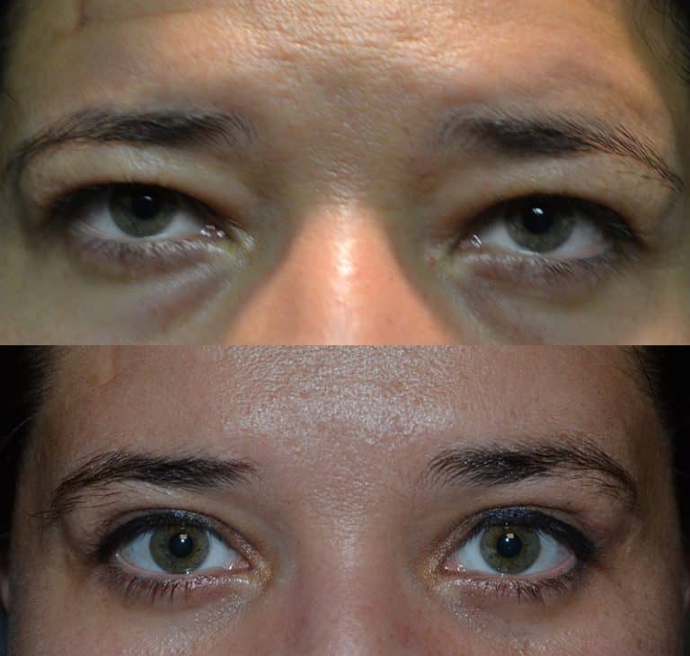 UPPER & LOWER EYELID SURGERY (BLEPHAROPLASTY) BEFORE & AFTER PHOTO. SURGERY BY DR. BALJEET K. PUREWAL (OCULOPLASTIC SURGEON) IN NEW JERSEY.