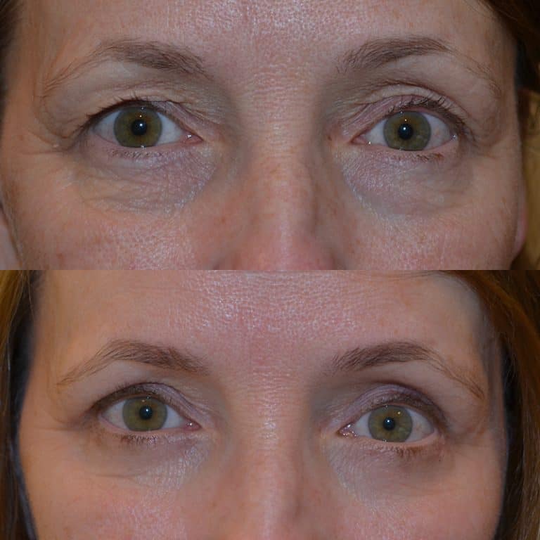 UPPER & LOWER EYELID SURGERY (BLEPHAROPLASTY) BEFORE & AFTER PHOTO. SURGERY BY DR. BALJEET K. PUREWAL (OCULOPLASTIC SURGEON) IN NEW JERSEY.