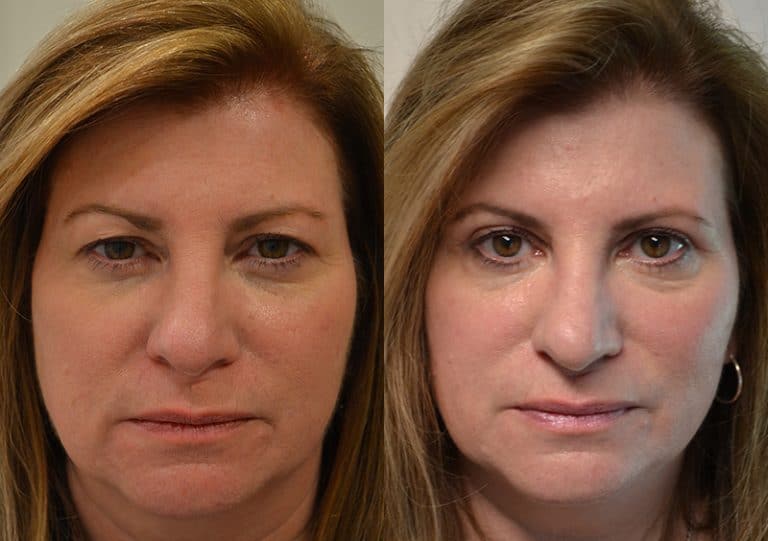 UPPER EYELID SURGERY (BLEPHAROPLASTY) BEFORE & AFTER PHOTO. SURGERY BY DR. BALJEET K. PUREWAL (OCULOPLASTIC SURGEON) IN NEW JERSEY.