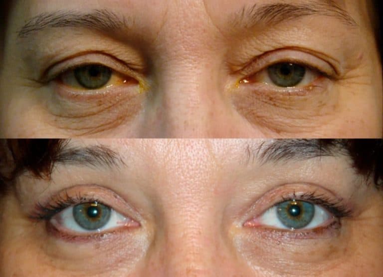 UPPER EYELID SURGERY (BLEPHAROPLASTY) BEFORE & AFTER PHOTO. SURGERY BY DR. BALJEET K. PUREWAL (OCULOPLASTIC SURGEON) IN NEW JERSEY.