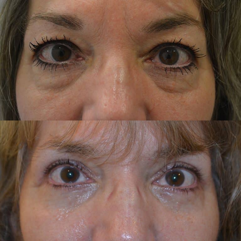 UPPER & LOWER EYELID SURGERY (BLEPHAROPLASTY) BEFORE & AFTER PHOTO. SURGERY BY DR. BALJEET K. PUREWAL (OCULOPLASTIC SURGEON) IN NEW JERSEY.