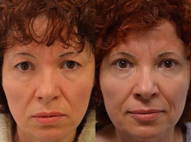 UPPER EYELID SURGERY (BLEPHAROPLASTY) BEFORE & AFTER PHOTO. SURGERY BY DR. BALJEET K. PUREWAL (OCULOPLASTIC SURGEON) IN NEW JERSEY.