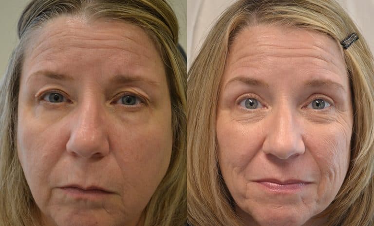 UPPER EYELID SURGERY (BLEPHAROPLASTY) BEFORE & AFTER PHOTO. SURGERY BY DR. BALJEET K. PUREWAL (OCULOPLASTIC SURGEON) IN NEW JERSEY.