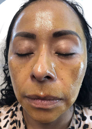 Chemical Peel Healing Case: Immediately After