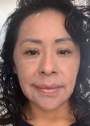 Chemical Peel Healing Case: Day 3