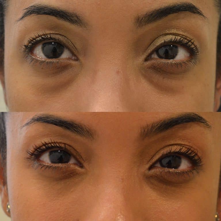 LOWER EYELID SURGERY (BLEPHAROPLASTY) BEFORE & AFTER PHOTO. SURGERY BY DR. BALJEET K. PUREWAL (OCULOPLASTIC SURGEON) IN NEW JERSEY.