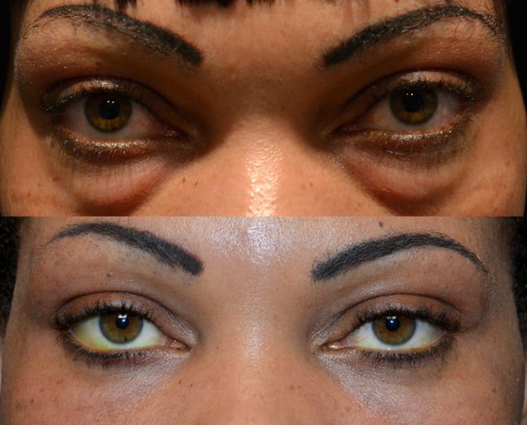 LOWER EYELID SURGERY (BLEPHAROPLASTY) BEFORE & AFTER PHOTO. SURGERY BY DR. BALJEET K. PUREWAL (OCULOPLASTIC SURGEON) IN NEW JERSEY.
