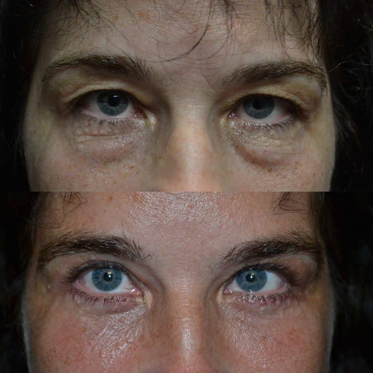 UPPER & LOWER EYELID SURGERY (BLEPHAROPLASTY) BEFORE & AFTER PHOTO. SURGERY BY DR. BALJEET K. PUREWAL (OCULOPLASTIC SURGEON) IN NEW JERSEY.