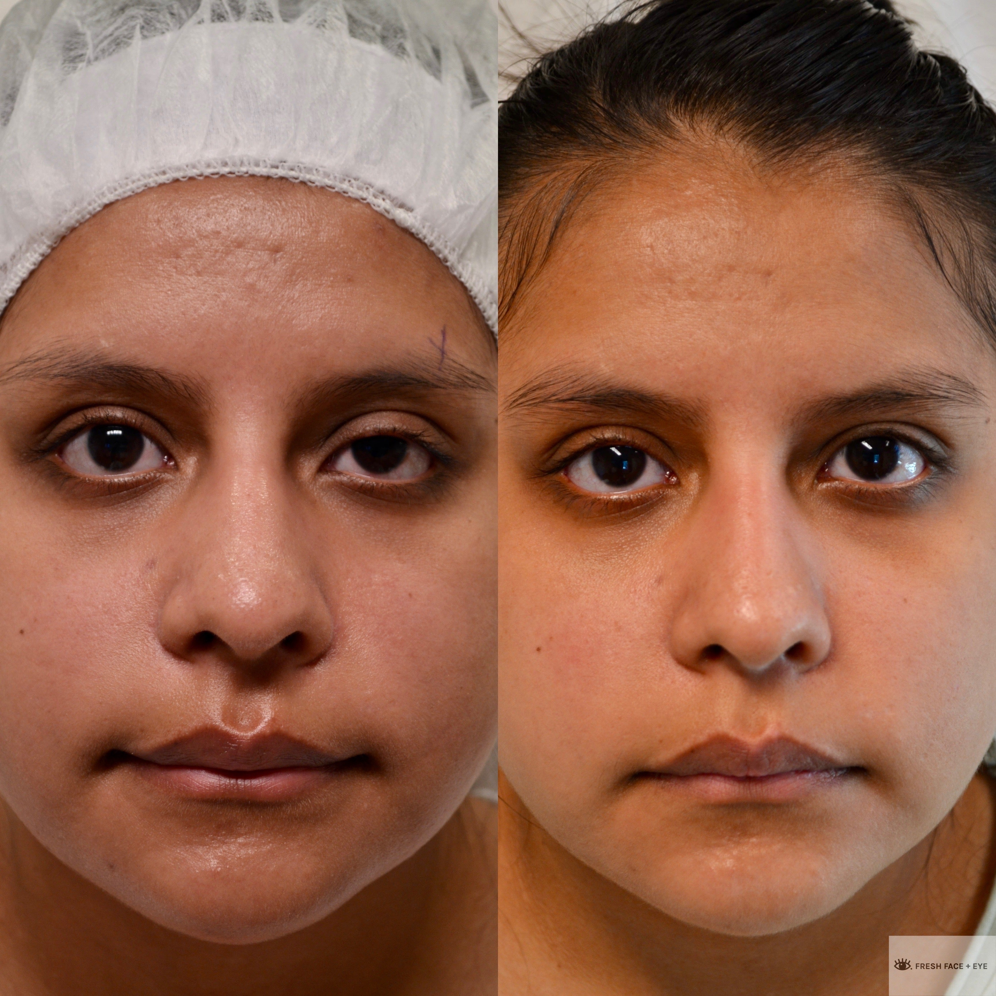 PTOSIS REPAIR BEFORE & AFTER PHOTO. SURGERY BY DR. BALJEET K. PUREWAL (OCULOPLASTIC SURGEON) IN NEW JERSEY.