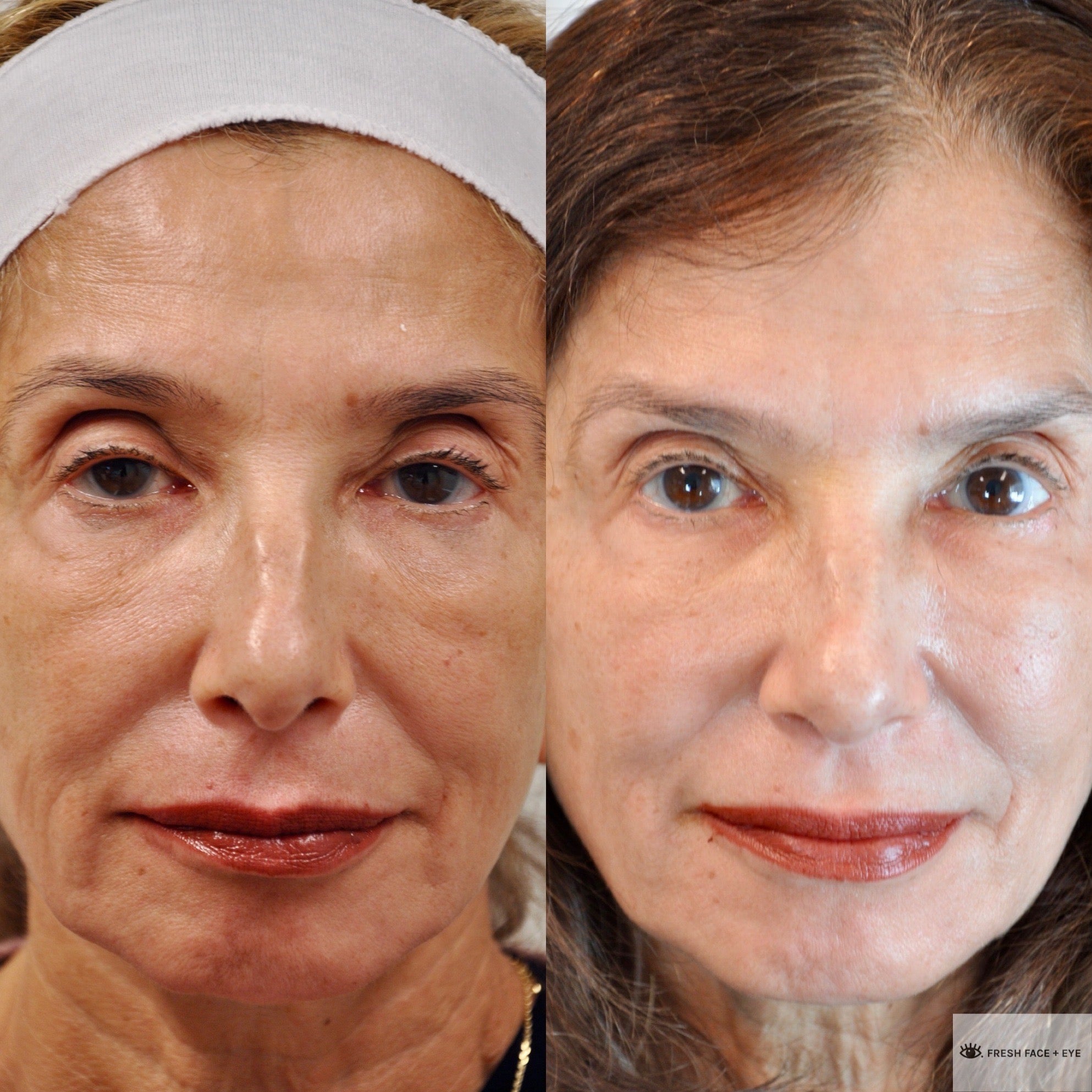 PTOSIS REPAIR BEFORE & AFTER PHOTO. PROCEDURE BY DR. BALJEET K. PUREWAL (OCULOPLASTIC SURGEON) IN NEW JERSEY.