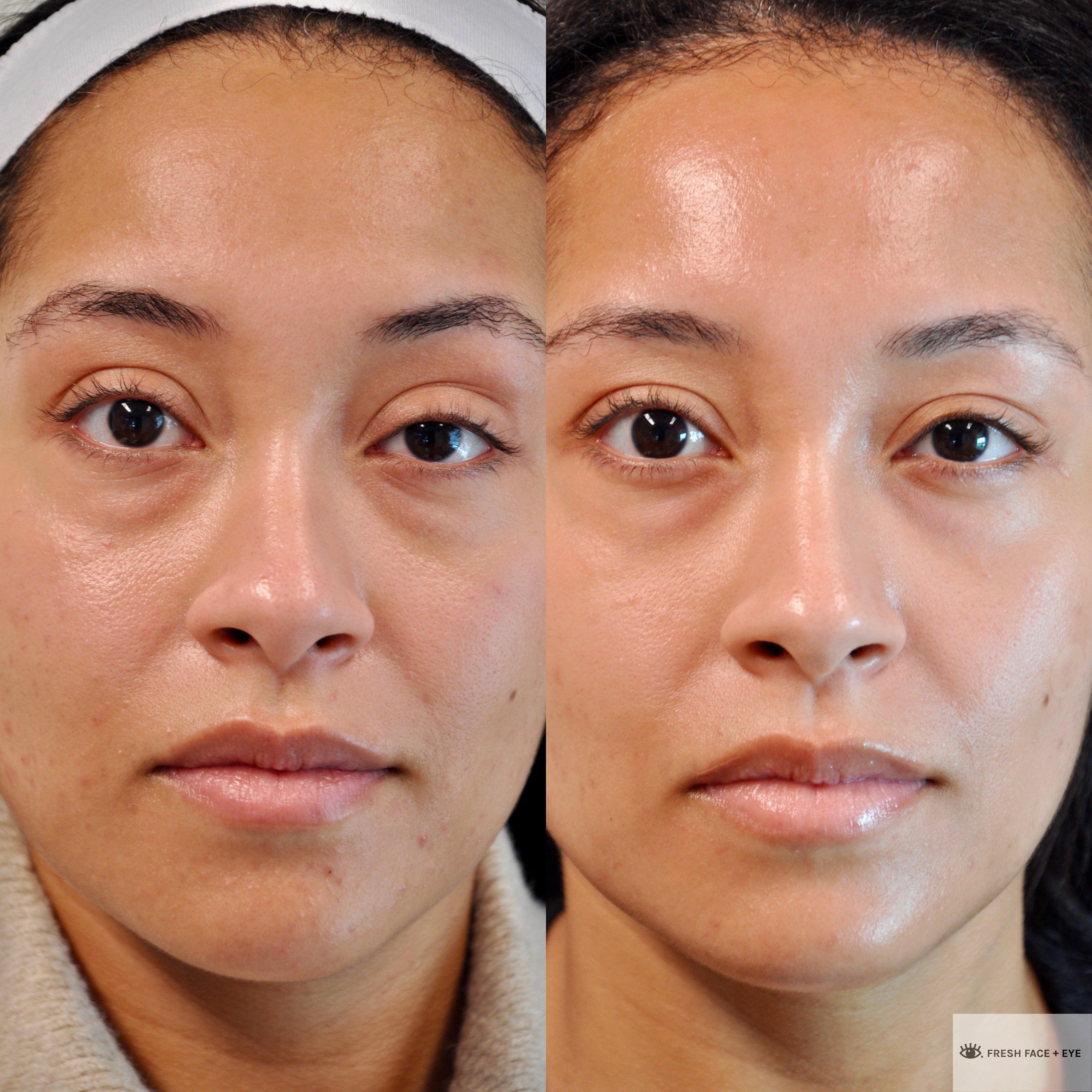 PTOSIS REPAIR BEFORE & AFTER PHOTO. PROCEDURE BY DR. BALJEET K. PUREWAL (OCULOPLASTIC SURGEON) IN NEW JERSEY.